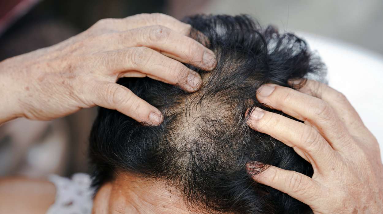 hair loss solutions in Bhubaneswar