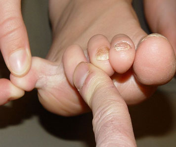 Fungal Infection Treatment in Bhubaneswar