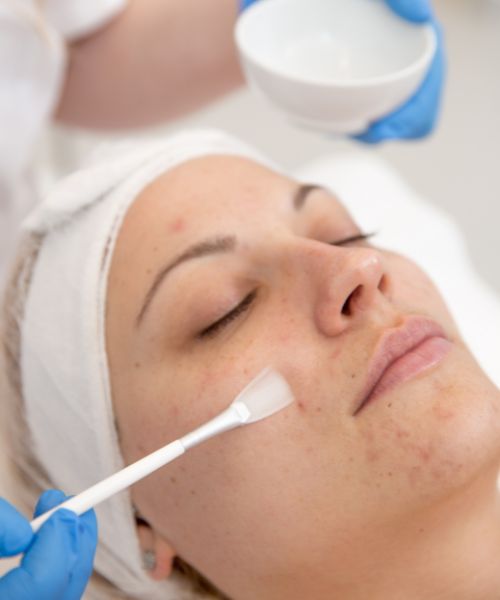 chemical peeling treatment in bhubaneswar