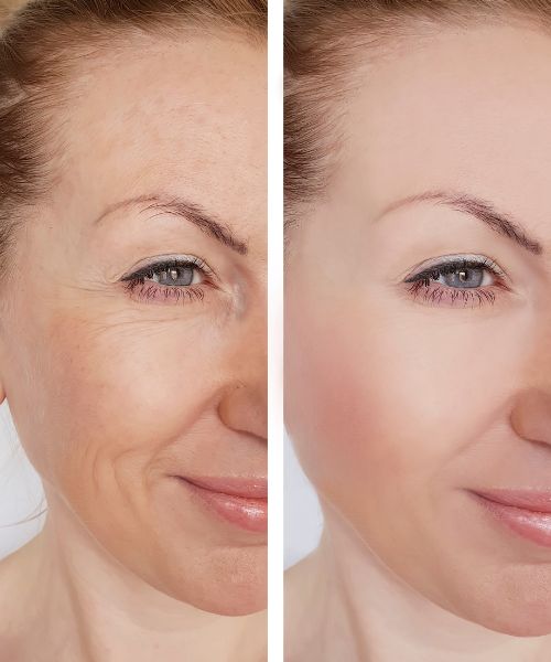 Facial Rejuvenation treatment in bhubaneswar